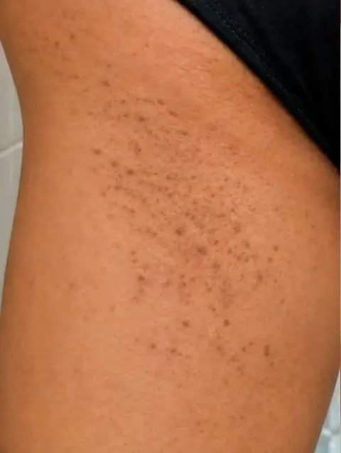 Virilha com foliculite antes do Sérum Clareador Maxfem
