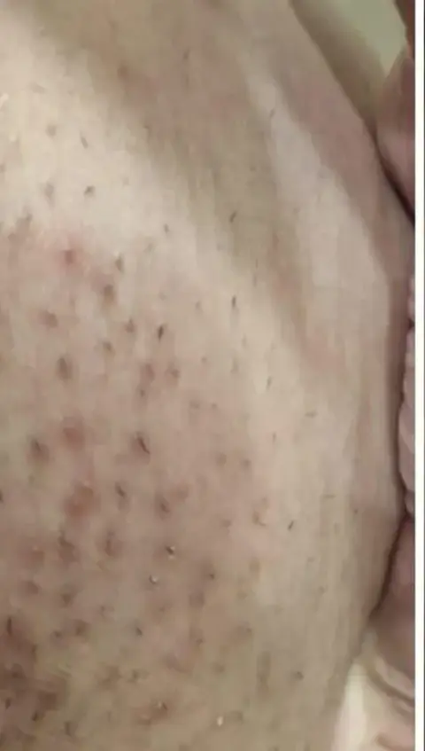 Virilha com foliculite antes do Sérum Clareador Maxfem