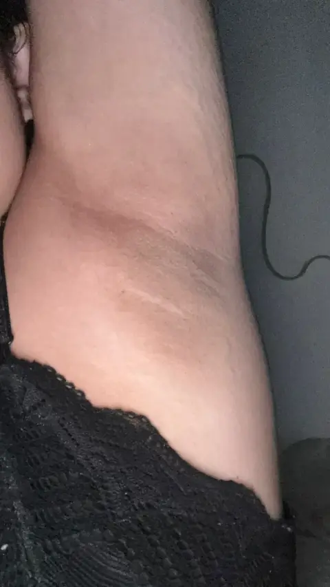Axila clareada depois do Sérum Clareador Maxfem