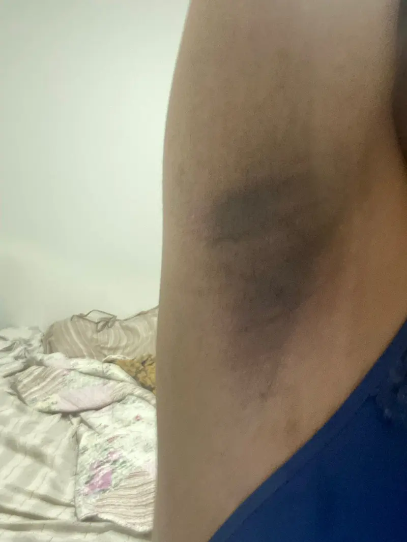 Axila antes do uso