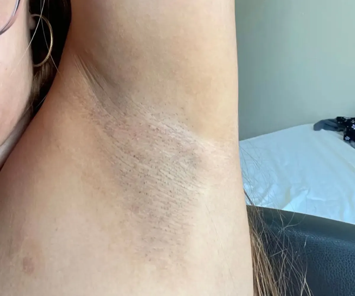 Axila após 8 semanas de uso