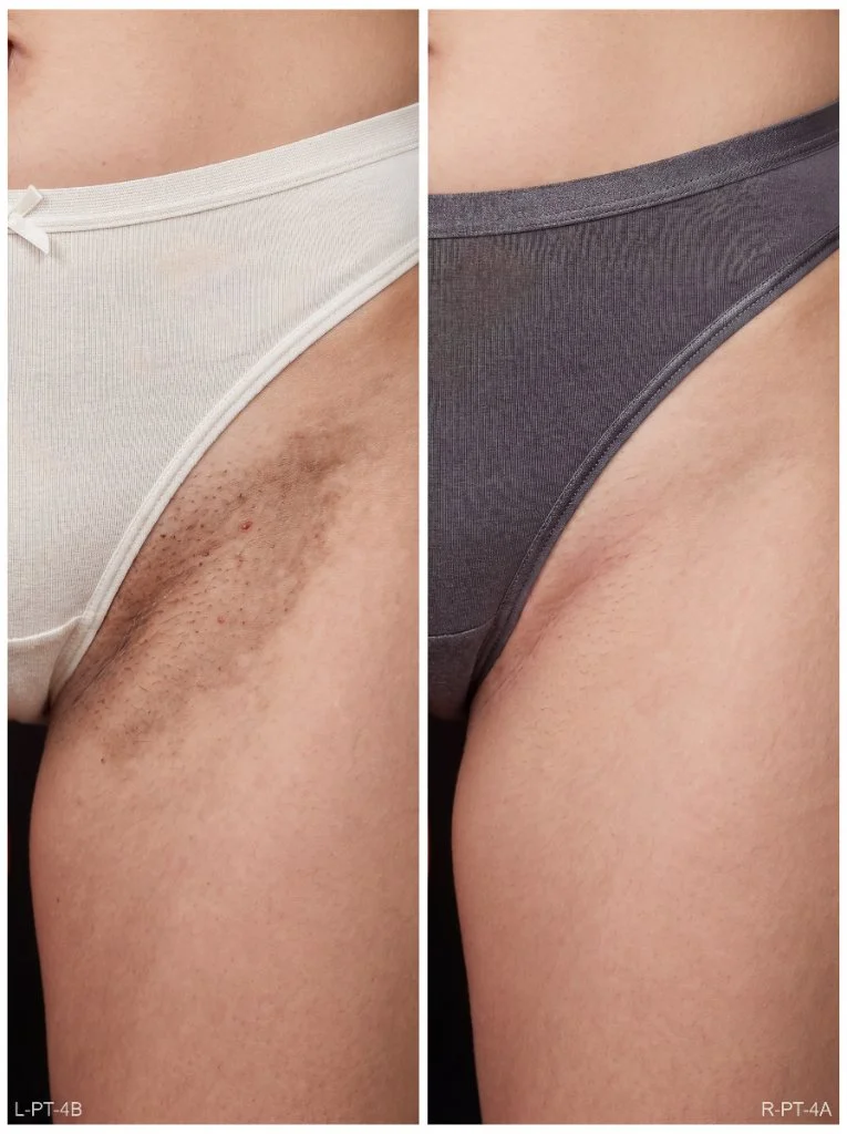 Virilha antes e depois do uso do Sérum Clareador Íntimo Maxfem