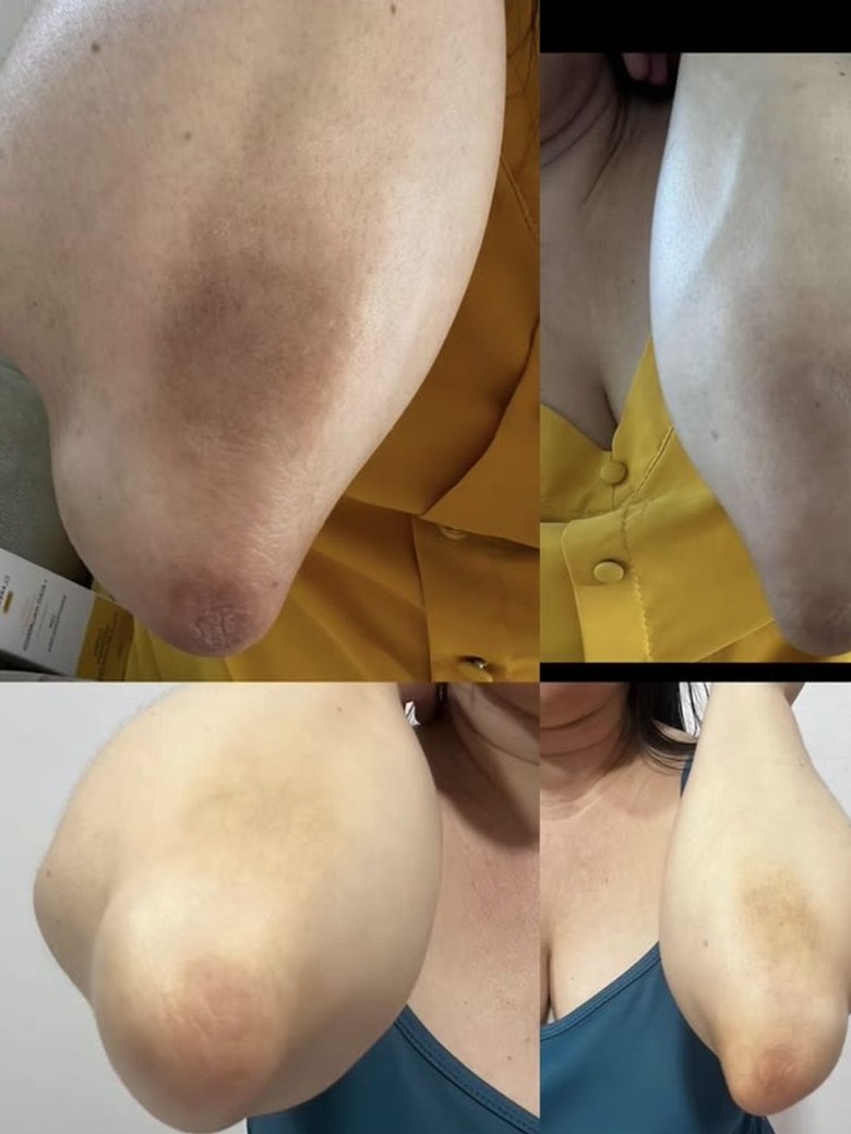 Foto da avaliação: cotovelo antes e depois de 2 meses de uso