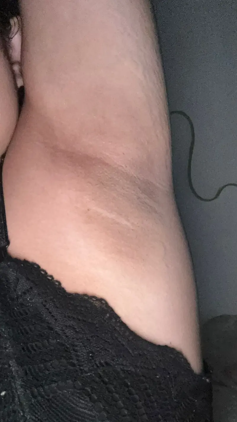 Axila após 6 semanas de uso