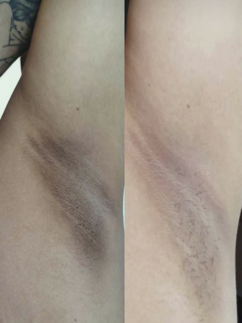 Avaliação de cliente: axila antes e depois de 12 dias de uso