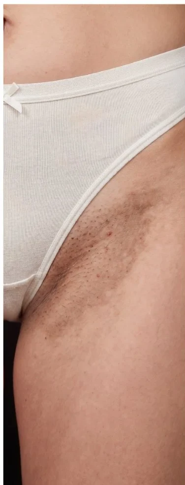 Virilha e linha do biquíni com manchas escuras, antes do uso do Sérum Clareador Íntimo Maxfem