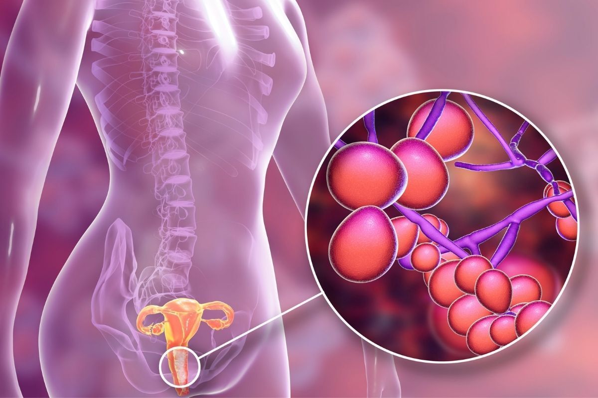 Ilustração do fungo Candida na região íntima feminina, com zoom nas leveduras e hifas